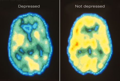 princ rm pet scan of depressed brain