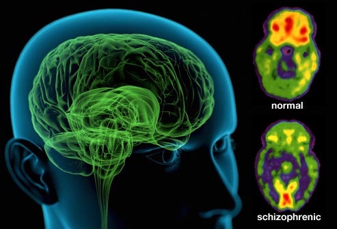 webmd rm photo of schizophrenic brain